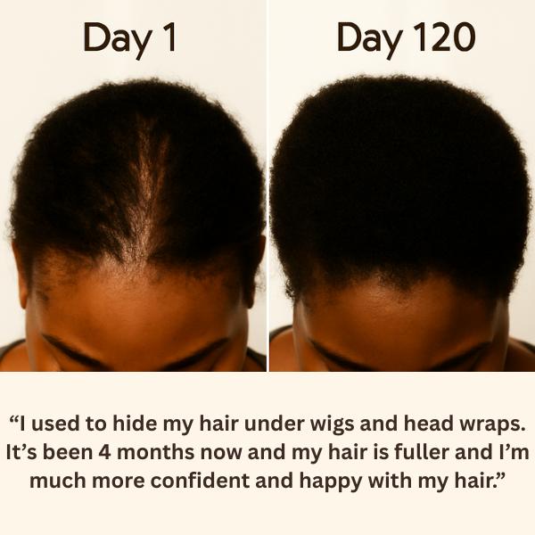 TheraCrown™ Root Revival Scalp Massager